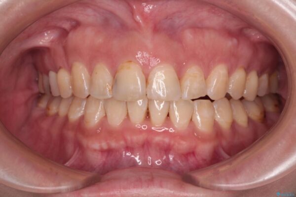 【モニター】飛び出た前歯を整えたい　ワイヤー矯正治療 治療後画像