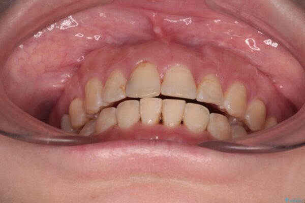 【モニター】飛び出た前歯を整えたい　ワイヤー矯正治療 治療後画像