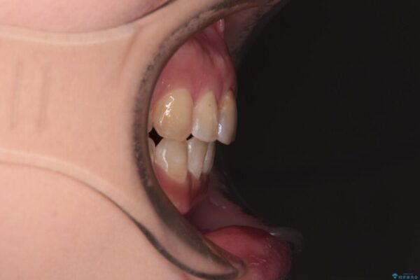 【モニター】飛び出た前歯を整えたい　ワイヤー矯正治療 アフター