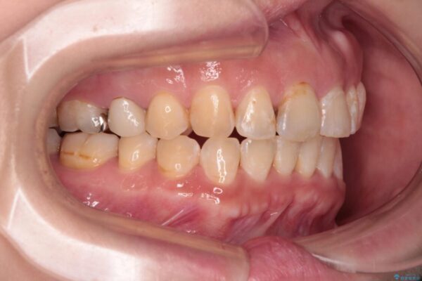 【モニター】飛び出た前歯を整えたい　ワイヤー矯正治療 治療後画像