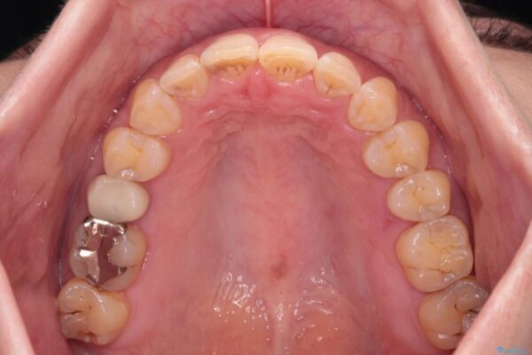 【モニター】飛び出た前歯を整えたい　ワイヤー矯正治療 治療後画像