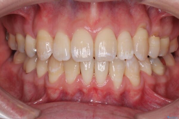 口元の突出感を改善!目立ちにくいワイヤー矯正で自信を持てる自然な横顔に 治療後画像