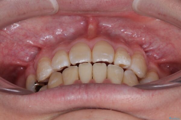 口元の突出感を改善!目立ちにくいワイヤー矯正で自信を持てる自然な横顔に 治療後画像