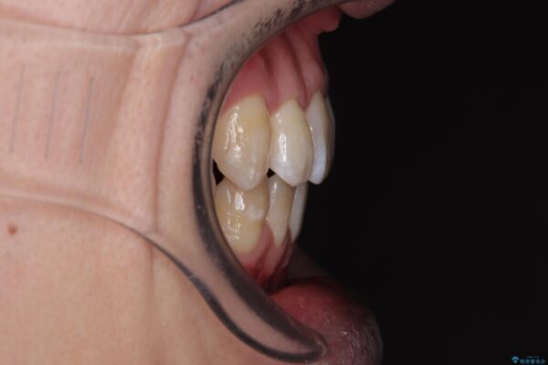 口元の突出感を改善!目立ちにくいワイヤー矯正で自信を持てる自然な横顔に アフター