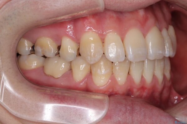 口元の突出感を改善!目立ちにくいワイヤー矯正で自信を持てる自然な横顔に 治療後画像