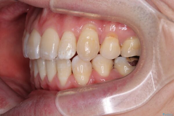 口元の突出感を改善!目立ちにくいワイヤー矯正で自信を持てる自然な横顔に 治療後画像