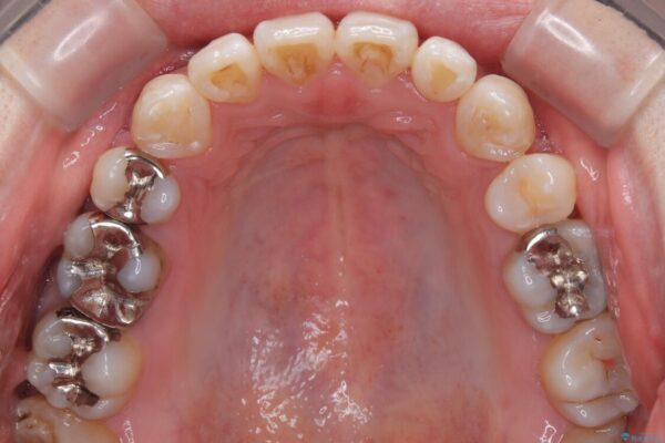 口元の突出感を改善!目立ちにくいワイヤー矯正で自信を持てる自然な横顔に 治療後画像