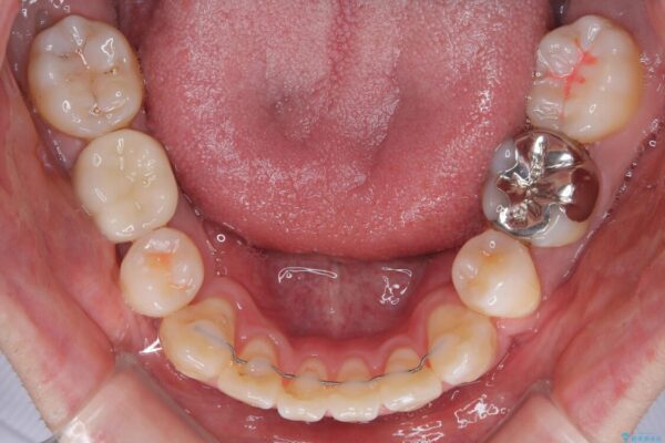 口元の突出感を改善!目立ちにくいワイヤー矯正で自信を持てる自然な横顔に 治療後画像