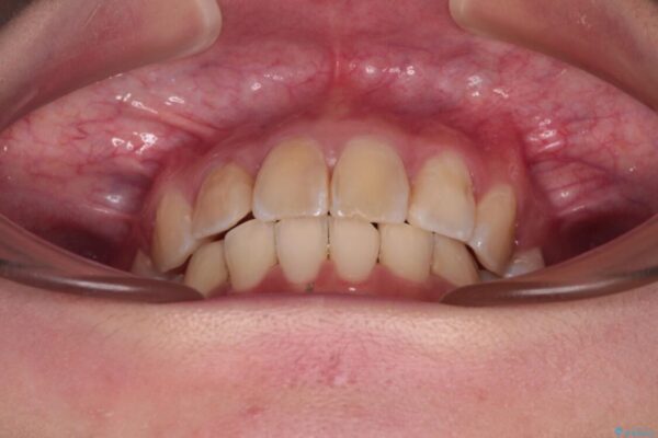 デコボコと深い咬み合わせ　ワイヤー装置での抜歯矯正 治療後画像