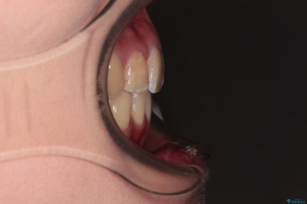 デコボコと深い咬み合わせ　ワイヤー装置での抜歯矯正 治療後画像