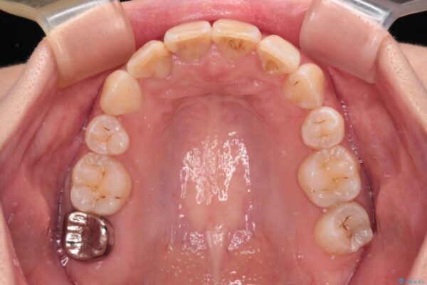 デコボコと深い咬み合わせ　ワイヤー装置での抜歯矯正 治療後画像