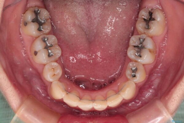 デコボコと深い咬み合わせ　ワイヤー装置での抜歯矯正 治療後画像