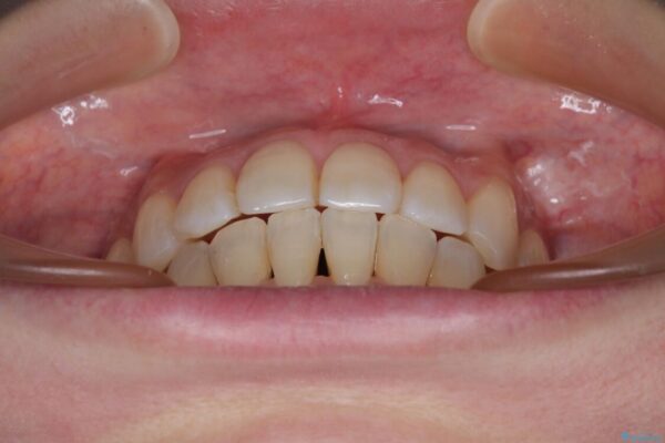インビザラインによる矯正治療と奥歯のインプラント治療 治療後画像