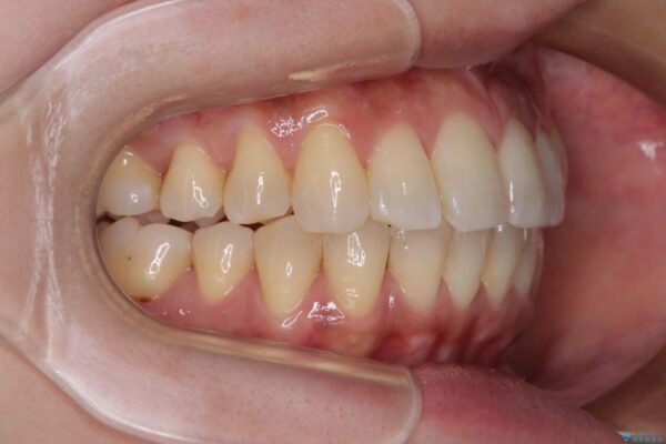 インビザラインによる矯正治療と奥歯のインプラント治療 治療後画像