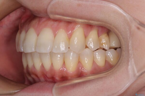 インビザラインによる矯正治療と奥歯のインプラント治療 治療後画像