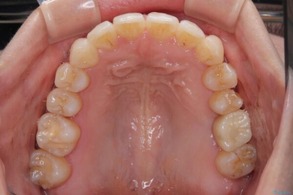 インビザラインによる矯正治療と奥歯のインプラント治療 治療後画像
