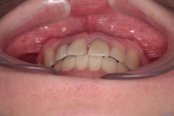 虫歯治療ついでに歯並びの後戻りを改善　インビザラインによる矯正治療 治療後画像
