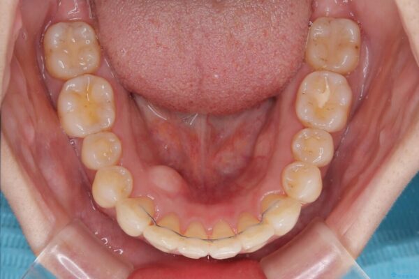 インビザラインによる矯正治療と奥歯のインプラント治療 治療後画像