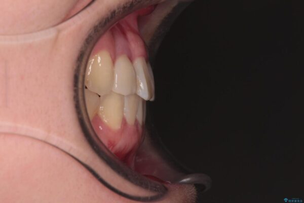 虫歯治療ついでに歯並びの後戻りを改善　インビザラインによる矯正治療 治療後画像