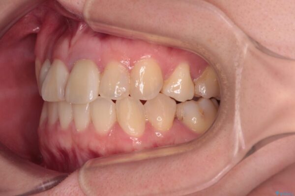 虫歯治療ついでに歯並びの後戻りを改善　インビザラインによる矯正治療 治療後画像