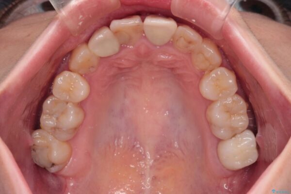 虫歯治療ついでに歯並びの後戻りを改善　インビザラインによる矯正治療 治療後画像
