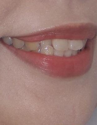 目立ちにくい表側装置で1年完了!狭いアーチを側方拡大し前歯のデコボコを整えた症例 治療前画像