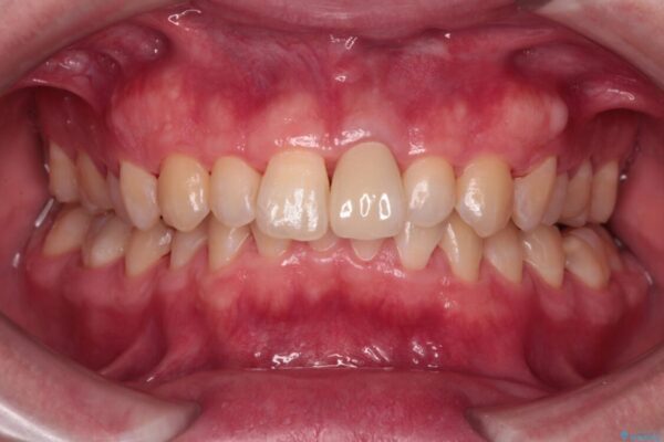 変色した前歯をオールセラミッククラウンに 治療後画像