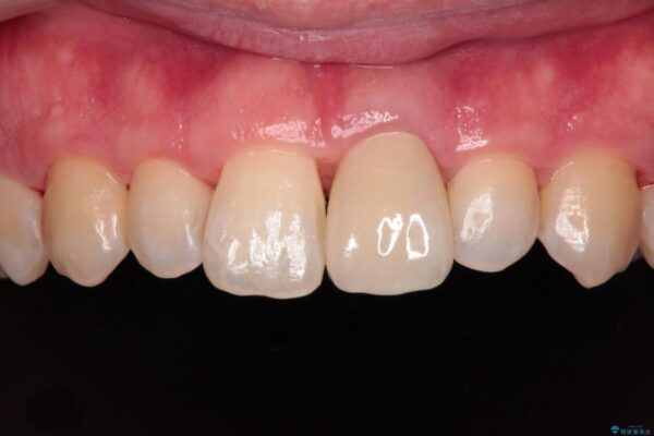 変色した前歯をオールセラミッククラウンに アフター