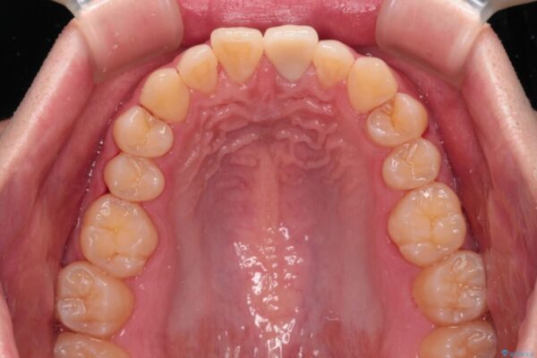 変色した前歯をオールセラミッククラウンに 治療後画像