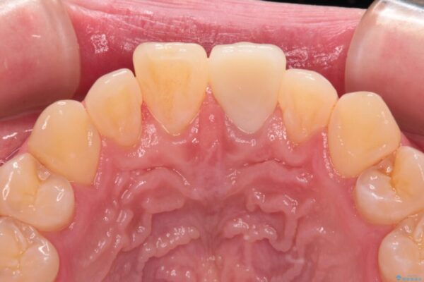 変色した前歯をオールセラミッククラウンに 治療後画像