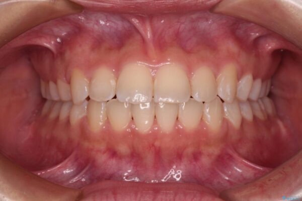 【モニター】短期間で終わりたい　ワイヤー装置での非抜歯矯正 アフター