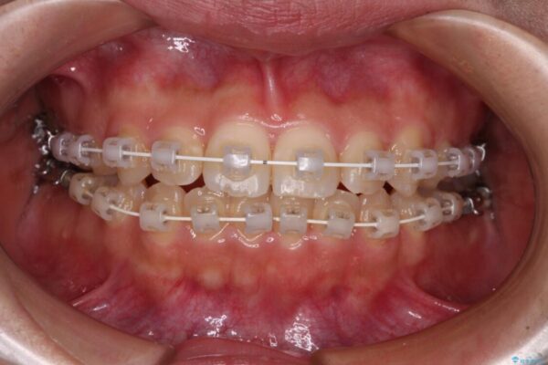 【モニター】短期間で終わりたい　ワイヤー装置での非抜歯矯正 治療途中画像