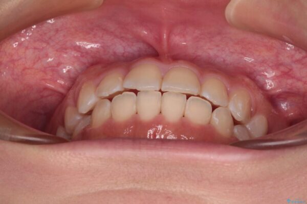 【モニター】短期間で終わりたい　ワイヤー装置での非抜歯矯正 治療後画像