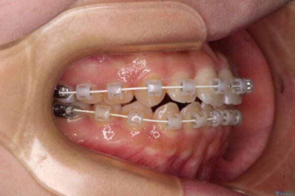 【モニター】短期間で終わりたい　ワイヤー装置での非抜歯矯正 治療途中画像