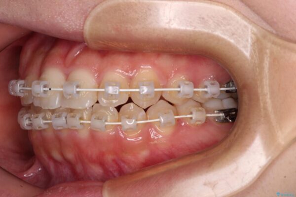 【モニター】短期間で終わりたい　ワイヤー装置での非抜歯矯正 治療途中画像