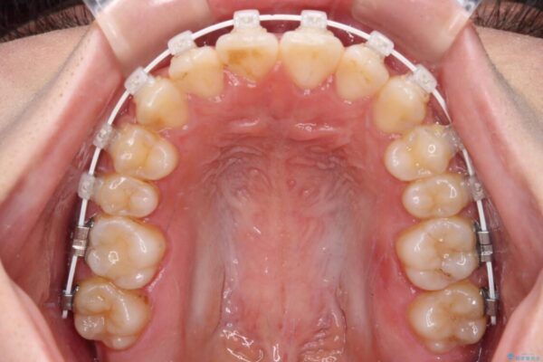 【モニター】短期間で終わりたい　ワイヤー装置での非抜歯矯正 治療途中画像