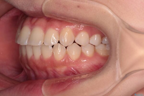 【モニター】短期間で終わりたい　ワイヤー装置での非抜歯矯正 治療後画像