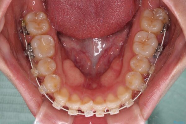 【モニター】短期間で終わりたい　ワイヤー装置での非抜歯矯正 治療途中画像