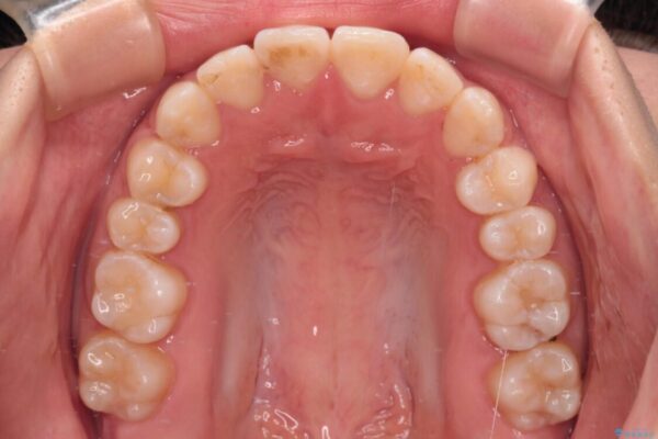 【モニター】短期間で終わりたい　ワイヤー装置での非抜歯矯正 治療後画像