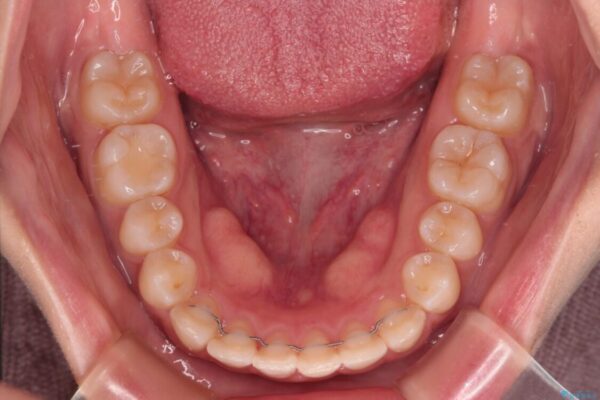 【モニター】短期間で終わりたい　ワイヤー装置での非抜歯矯正 治療後画像