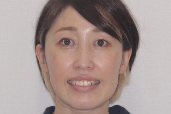 【モニター】カリエール・ディスタライザーを併用した八重歯のインビザライン矯正 治療前画像