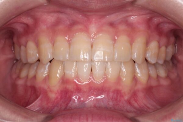 【モニター】下顎前歯のデコボコをインビザラインできれいに アフター