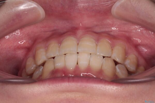 【モニター】下顎前歯のデコボコをインビザラインできれいに 治療後画像