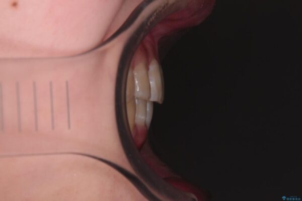 【モニター】下顎前歯のデコボコをインビザラインできれいに 治療後画像