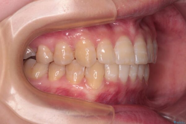 【モニター】下顎前歯のデコボコをインビザラインできれいに 治療後画像