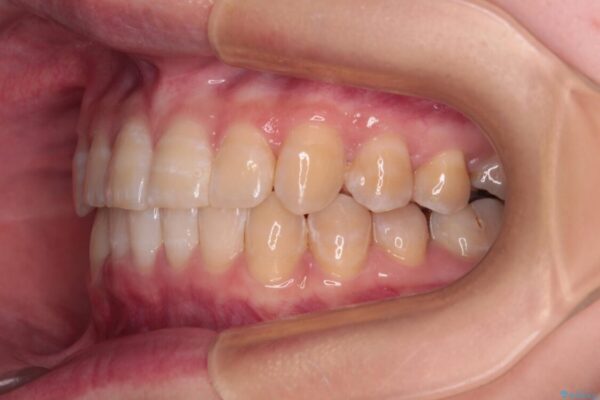 【モニター】下顎前歯のデコボコをインビザラインできれいに 治療後画像