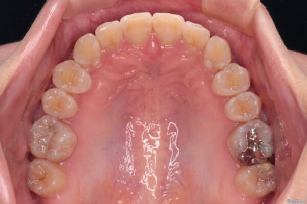 【モニター】下顎前歯のデコボコをインビザラインできれいに 治療後画像