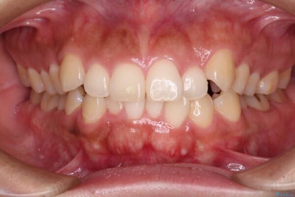 【モニター】カリエール・ディスタライザーを併用した八重歯のインビザライン矯正 ビフォー