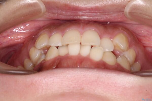 【モニター】カリエール・ディスタライザーを併用した八重歯のインビザライン矯正 治療前画像