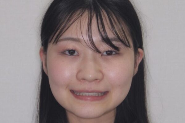 【モニター】下顎前歯のデコボコをインビザラインできれいに 治療後画像